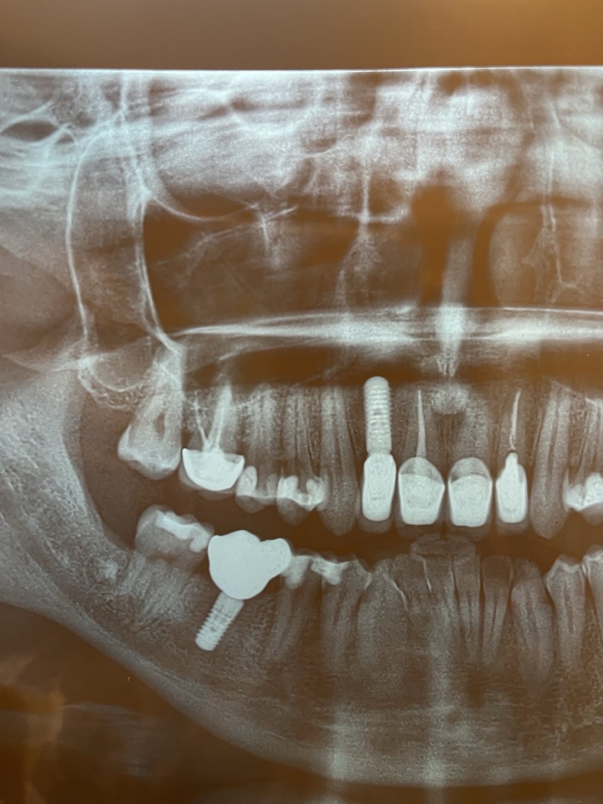 Implants Schtraumann 12, 46