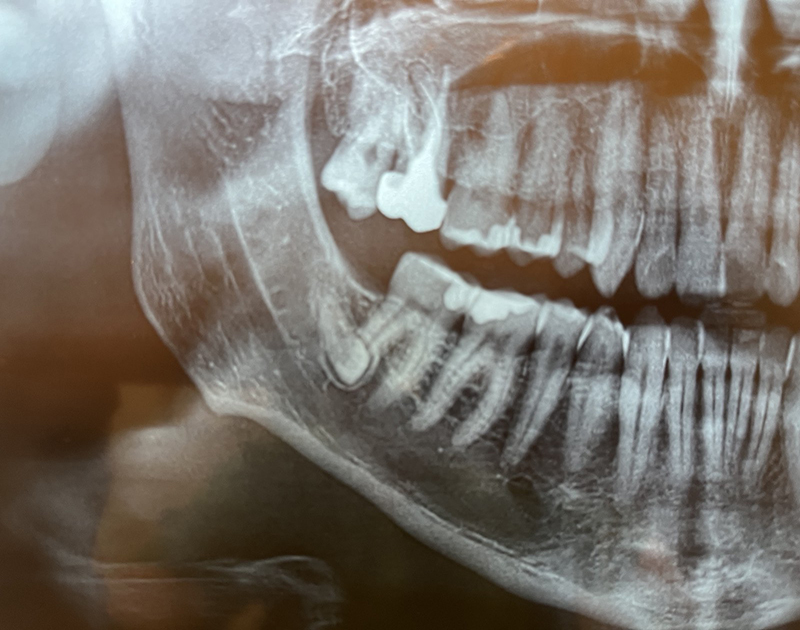 Xray tooth extraction