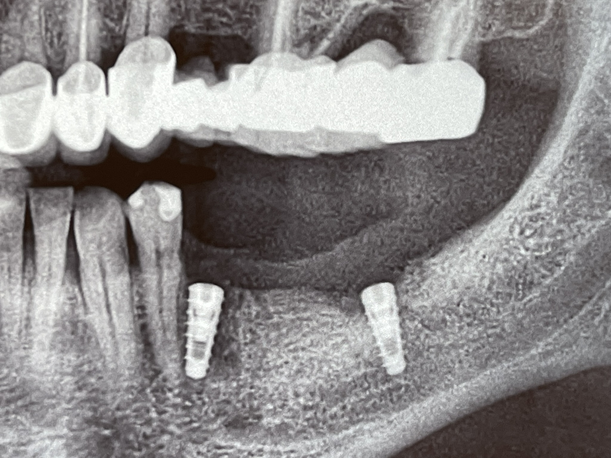 Immediate implants: The second step - implant placement