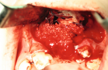 mixing the bone substitute material with the blood and placing it in the defect