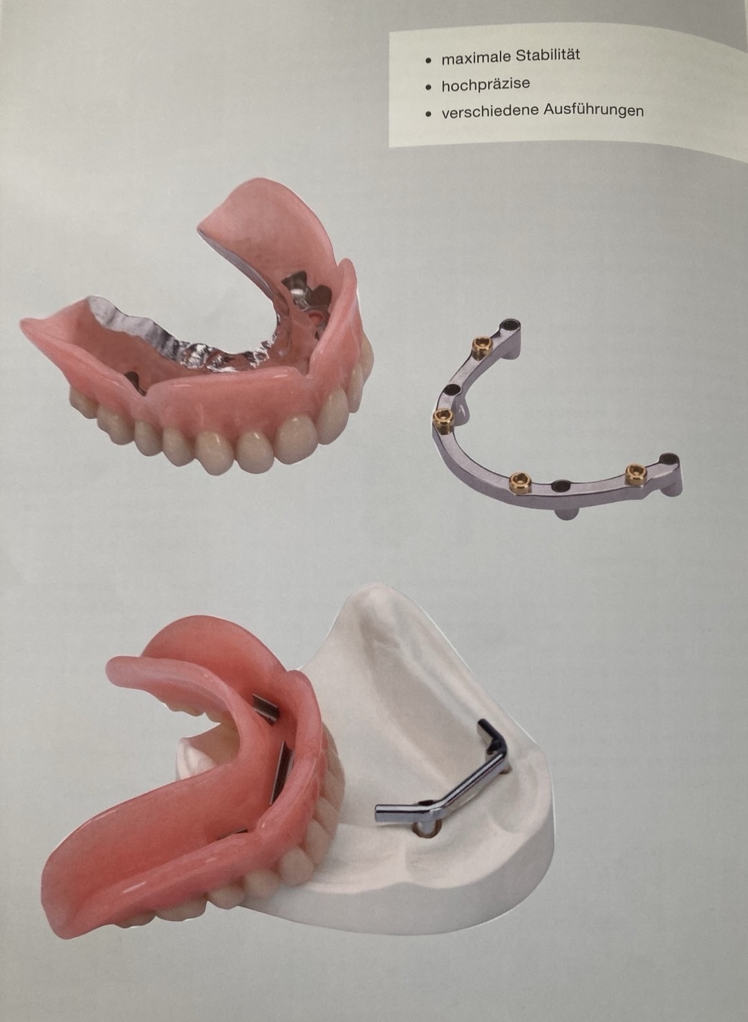 Removable prosthetic construction of 4 implants on the upper jaw and two implants on the lower jaw connected to the traverse in patients without teeth - the advantage is that the patient can clean the implants well by removing the construction for cleaning. This is a very important indicator for the long-term prognosis of the implants.