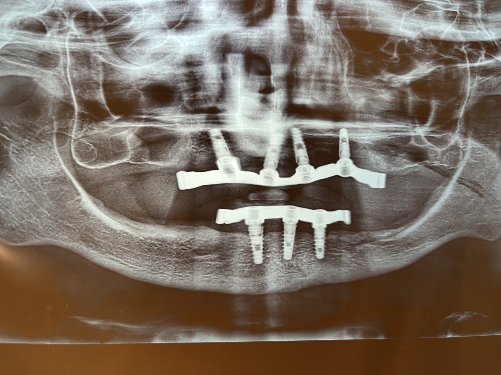 X-ray Photo X-ray Photo