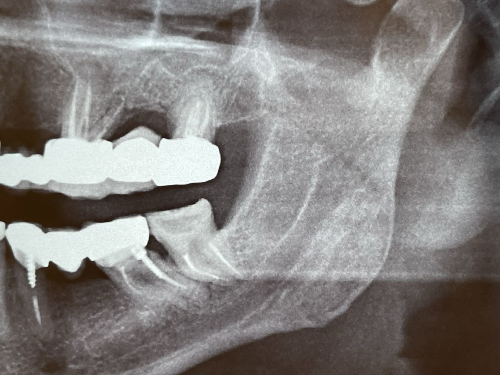Immediate implants: First step - remove a tooth