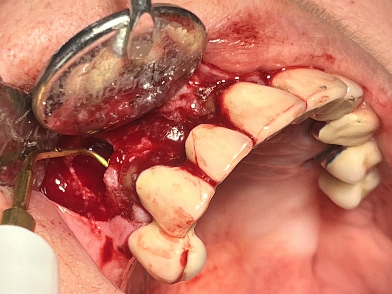 Tooth 13 has a radicular cyst, a root resection was performed in order to preserve the tooth Tooth 13 has a radicular cyst, a root resection was performed in order to preserve the tooth